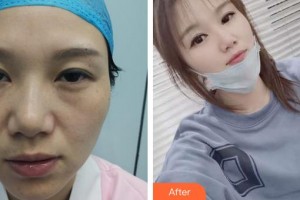 成都柏菲絲醫(yī)學美容門診部蘇瑋智整形價格表附面部吸脂案例展示