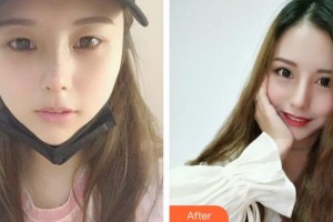 成都明星醫(yī)療美容門診部管謀整形價格表附眼部綜合案例展示