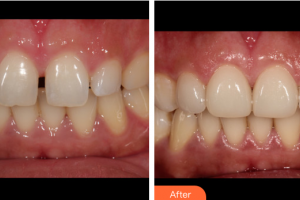 廣州海峽醫(yī)學(xué)整形美容醫(yī)院周顯峰整形價格表附牙齒貼面案例展示