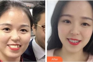 成都景華醫(yī)學美容門診部華越整形價格表附牙綜合案例展示