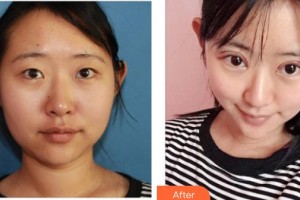 成都艾美薇醫(yī)療美容門診部何珊珊整形價格表附雙眼皮案例展示