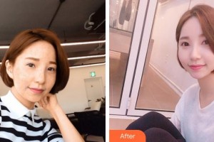 成都柏菲絲醫(yī)學美容門診部唐豪悅整形價格表附果酸祛痘案例展示