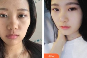 成都瑞美薈醫(yī)療美容醫(yī)院董理整形價格表附鼻部手術案例展示