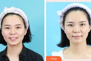 成都百齡駐顏醫(yī)學美容門診部張美琳整形價格表附激光美膚祛斑案例展示