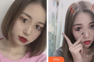 成都赫拉醫(yī)療美容整形醫(yī)院曾俊君整形價格表附下頜緣瘦臉術案例展示