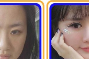 成都如悅醫(yī)療美容醫(yī)院徐進整形價格表附眼部手術+脂肪案例展示