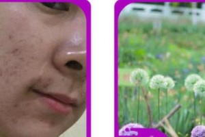 成都修膚堂皮膚病診所伍玉梅整形價格表附祛痘案例展示