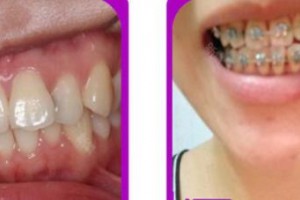 成都華美牙科悅齒門診部鐘果成整形價格表附牙齒矯正案例展示