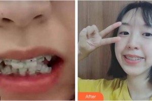 成都華美牙科悅齒門診部劉永桂整形價格表附牙齒矯正案例展示