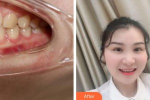 成都瑞泰融誠口腔醫(yī)院孫勁東整形價格表附半隱形牙齒矯正案例展示