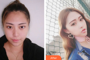 廣州海峽醫(yī)學(xué)整形美容醫(yī)院李冠穎整形價格表附鼻部手術(shù)案例展示