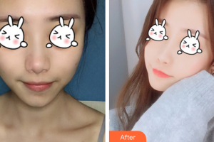 廣州海峽醫(yī)學(xué)整形美容醫(yī)院廖奇峰整形價格表附光子嫩膚案例展示