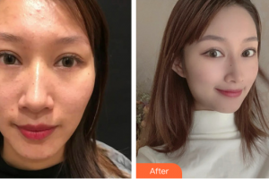 廣州紫馨美容醫(yī)院劉晉艷整形價格表附微針祛痘案例展示