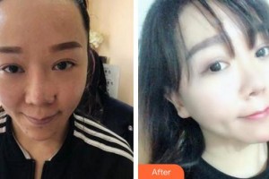 成都首瑞毛發(fā)移植醫(yī)療美容診所汪軍院長整形價格表附植發(fā)案例展示