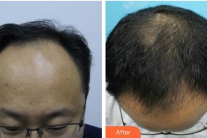 成都博愛醫(yī)院（胎記美容中心）余紅彬整形價格表附植發(fā)案例展示