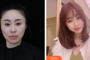 廣州海峽醫(yī)學(xué)整形美容醫(yī)院雷浚嶸整形價格表附膠原蛋白除皺案例展示