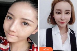 成都潤禾皮膚病?？漆t(yī)院殷明坤整形價格表附祛斑案例展示