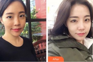 成都潤禾皮膚病?？漆t(yī)院李艷整形價格表附祛痘美膚案例展示