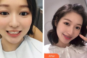 成都美上美醫(yī)療美容醫(yī)院張強(qiáng)富整形價格表附牙齒矯正案例展示