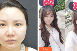 廣州軍區(qū)武漢總醫(yī)院醫(yī)學(xué)整形美容中心郭亮整形價格表附面部輪廓案例展示