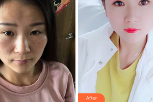 廣州軍區(qū)武漢總醫(yī)院醫(yī)學(xué)整形美容中心孔生生整形價格表附激光祛斑案例展示