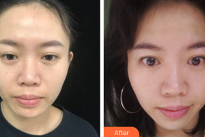 廣州軍區(qū)武漢總醫(yī)院醫(yī)學(xué)整形美容中心彭靜整形價格表附二氧化碳點陣激光案例展示