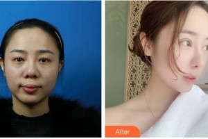 成都安莎貝拉醫(yī)療美容門(mén)診部文惠英整形價(jià)格表附鼻部綜合案例展示