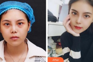 成都臻愛(ài)唯美醫(yī)療美容醫(yī)院王皓民整形價(jià)格表附隆鼻案例展示