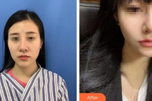 成都晶都醫(yī)療美容醫(yī)院林鴻祥整形價(jià)格表附多方面部埋線(xiàn)提升案例展示