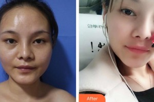 成都綠葉愛(ài)麗美婦產(chǎn)科醫(yī)院醫(yī)療美容科何鵬整形價(jià)格表附自體脂肪填充案例展示