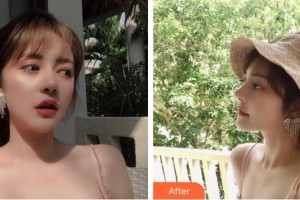 成都晶都醫(yī)療美容醫(yī)院王芳整形價(jià)格表附活氧煥膚案例展示