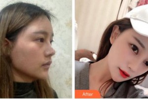 成都百媚生醫(yī)療美容門(mén)診部宴國(guó)富整形價(jià)格表附鼻部手術(shù)案例展示