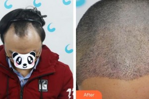 成都絲緣毛發(fā)醫(yī)療美容門(mén)診部陳戰(zhàn)兵整形價(jià)格表附植發(fā)案例展示