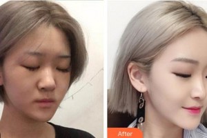 成都暄妍醫(yī)療美容門(mén)診部潘寧整形價(jià)格表附鼻部手術(shù)整形案例展示