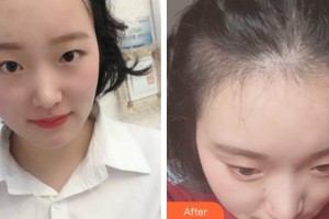 成都絲緣毛發(fā)醫(yī)療美容門(mén)診部陳祖慶整形價(jià)格表附植發(fā)案例展示