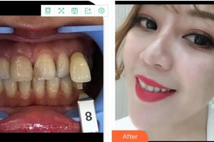 成都茁悅口腔診所羅鴻思整形價格表附牙齒美白案例展示