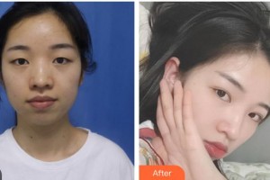 成都愛爾眼科醫(yī)院樊映川整形價格表附眼部綜合案例展示