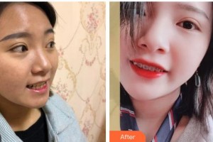 成都茁悅口腔診所吳忠敏整形價(jià)格表附牙齒矯正案例展示