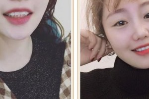 成都康橋眼科醫(yī)院鄭海燕整形價(jià)格表附隱形矯正案例展示