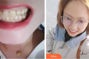 成都茁悅口腔診所李文星整形價(jià)格表附牙齒矯正案例展示