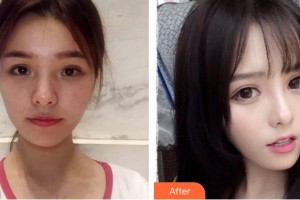 成都愛(ài)迪眼科醫(yī)院曾慶華整形價(jià)格表附眼部綜合案例展示