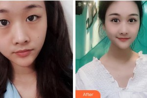 成都愛(ài)迪眼科醫(yī)院康黔整形價(jià)格表附雙眼皮案例展示