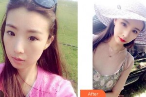 成都愛(ài)迪眼科醫(yī)院鄧彥整形價(jià)格表附眼部綜合案例展示