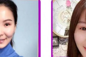 成都愛(ài)迪眼科醫(yī)院晏大倫整形價(jià)格表附雙眼皮案例展示