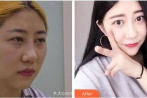 成都愛(ài)迪眼科醫(yī)院李綱整形價(jià)格表附雙眼皮案例展示