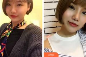 成都愛(ài)迪眼科醫(yī)院吳瑛整形價(jià)格表附眼部整形案例展示