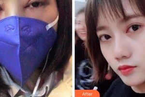 成都愛(ài)迪眼科醫(yī)院文林整形價(jià)格表附眼部整形案例展示