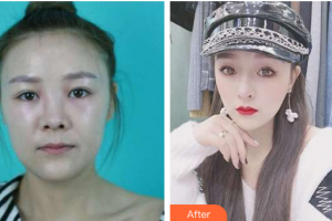 廣州軍區(qū)武漢總醫(yī)院醫(yī)學(xué)整形美容中心孫艷春整形價格表附面包臉到鴨蛋臉變形記案例展示