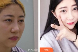 成都愛(ài)迪眼科醫(yī)院張軍軍整形價(jià)格表附全切雙眼皮案例展示