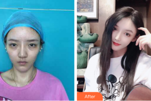 廣州晨曦醫(yī)療美容醫(yī)院宋寅洙整形價格表附假體眉弓案例展示